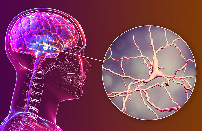 Huzursuz Bacak Sendromu